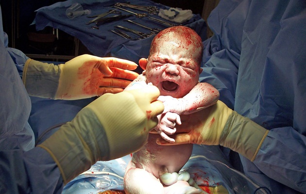 საკეისრო კვეთა