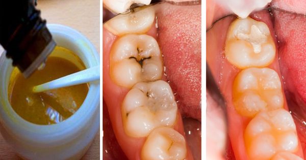 როგორ ვუმკურნალოთ კარიესს