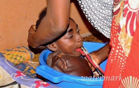 ძალიან მძიმე ისტორია გოგონაზე, რომელმაც 6 თვის ასაკიდან ზრდა შეწყვიტა ! ძალიან მძიმე ისტორია გოგონაზე, რომელმაც 6 თვის ასაკიდან ზრდა შეწყვიტა !