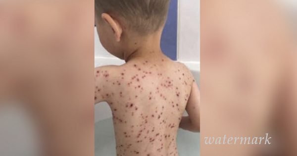 რამ შეიძლება გამოიწვიოს სავალალო შემთხვევა ჩუტყვავილის დროს. ეს ყველა მშობელმა უნდა იცოდეს !