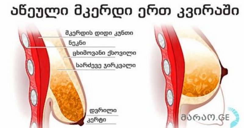 მკერდის გაზრდა და გამკვრივება ოპერაციის გარეშე ერთ კვირაში!!!