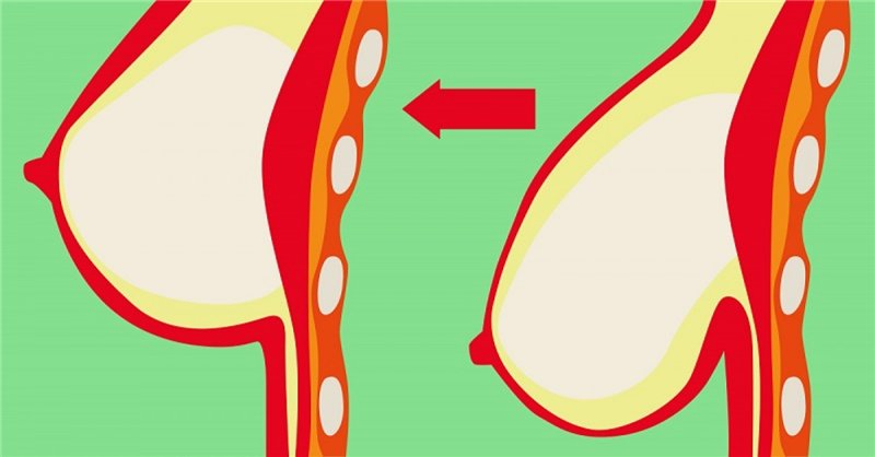 როგორ დავუბრუნოთ ფორმა ჩამოშვებულ მკერდს? - გთავაზობთ რამდენიმე ხრიკს