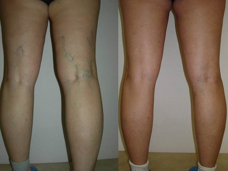 ვარიკოზული ვენების ეფექტური სამკურნალო საშუალება!