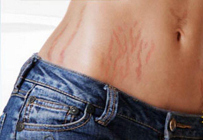 ფეხმძიმობა და სტრიები