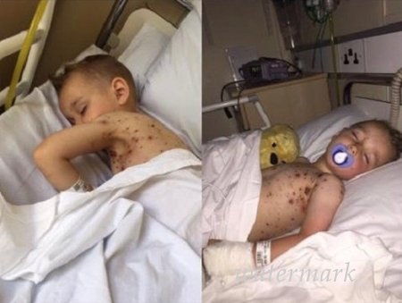 რამ შეიძლება გამოიწვიოს სავალალო შემთხვევა ჩუტყვავილის დროს. ეს ყველა მშობელმა უნდა იცოდეს ! რამ შეიძლება გამოიწვიოს სავალალო შემთხვევა ჩუტყვავილის დროს. ეს ყველა მშობელმა უნდა იცოდეს !