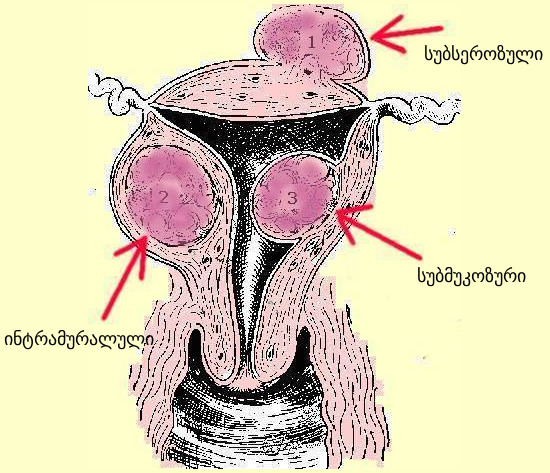 საშვილოსნოს მიომა, ორსულობა და მშობიარობა