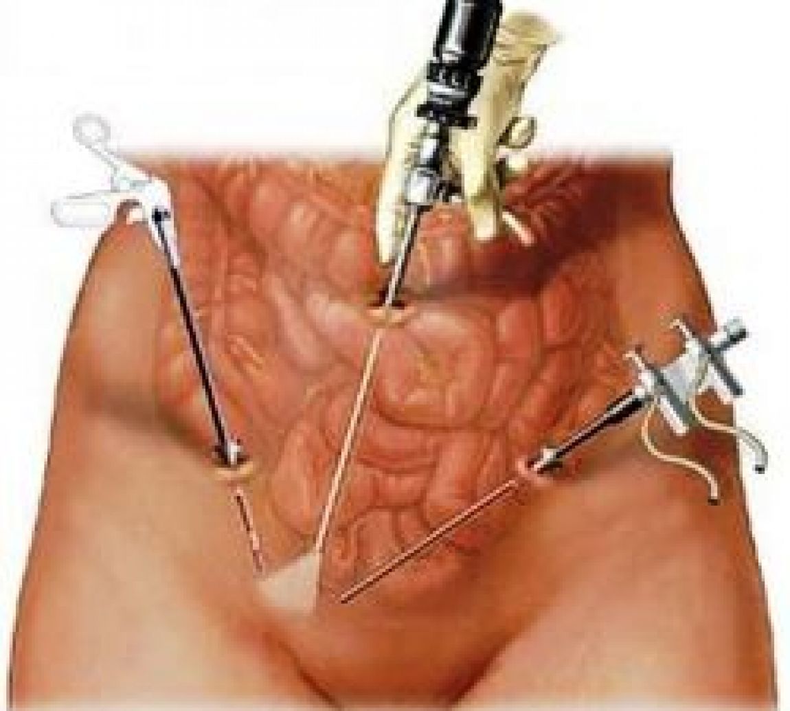 საშვილოსნოს გარე ორსულობა