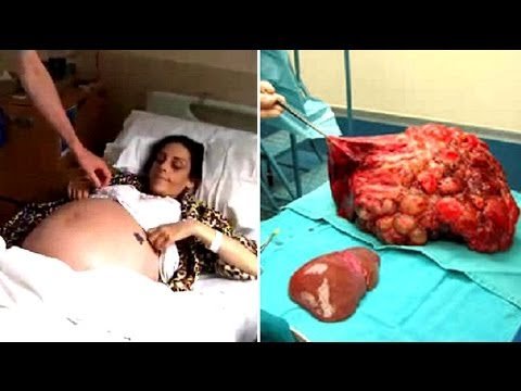 ყველას ეგონა რომ ქალი ფეხმძიმედ იყო, მაგრამ სიმართლე შოკისმომგვრელი