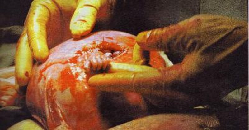 შემთხვევა, რომელმაც მსოფლიო შეძრა: 21 კვირის ჩანასახი მადლიერების ნიშნად თითს წაეტანა!