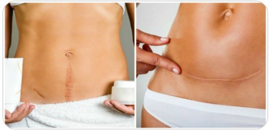 საკეისრო კვეთის შემდეგ რატომ აქვთ ქალების ნაწილს ჭრილობა ვერტიკალურად, ნაწილს კი ჰორიზონტალურად?